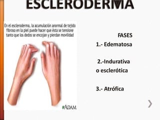 FASES
1.- Edematosa
2.-Indurativa
o esclerótica
3.- Atrófica
 
