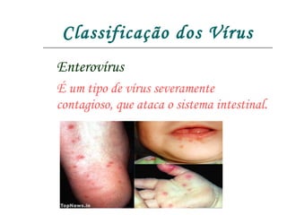 Classificação dos Vírus Enterovírus É um tipo de vírus severamente contagioso, que ataca o sistema intestinal. 