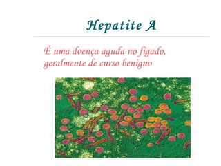 Hepatite A É uma doença aguda no fígado, geralmente de curso benigno  
