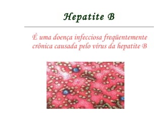 Hepatite B É uma doença infecciosa freqüentemente crônica causada pelo vírus da hepatite B   
