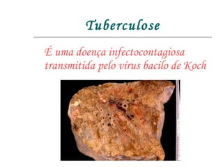 Tuberculose É uma doença infectocontagiosa transmitida pelo vírus bacilo de Koch 
