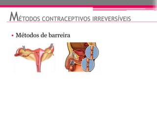 MÉTODOS CONTRACEPTIVOS IRREVERSÍVEIS
• Métodos de barreira
 