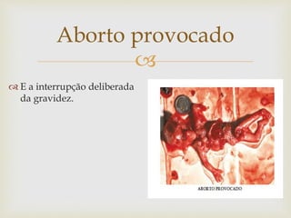 
Aborto provocado
 E a interrupção deliberada
da gravidez.
 