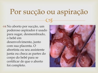 
Por sucção ou aspiração
 No aborto por sucção, um
poderoso aspirador é usado
para sugar, desmembrado,
o bebê em
desenvolvimento, junto
com sua placenta. O
abortista ou seu assistente
junta ou checa as partes do
corpo do bebê para se
certificar de que o aborto
foi completo.
 
