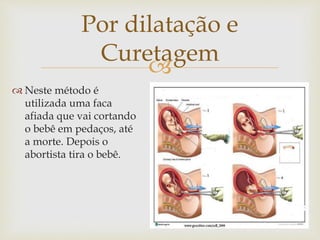 
Por dilatação e
Curetagem
 Neste método é
utilizada uma faca
afiada que vai cortando
o bebê em pedaços, até
a morte. Depois o
abortista tira o bebê.
 