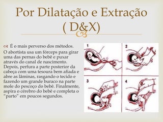 
Por Dilatação e Extração
( D&X)
 É o mais perverso dos métodos.
O abortista usa um fórceps para girar
uma das pernas do bebê e puxar
através do canal de nascimento.
Depois, perfura a parte posterior da
cabeça com uma tesoura bem afiada e
abre as lâminas, rasgando o tecido e
fazendo um grande buraco na parte
mole do pescoço do bebê. Finalmente,
aspira o cérebro do bebê e completa o
“parto” em poucos segundos.
 