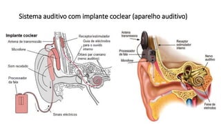 Sistema auditivo com implante coclear (aparelho auditivo)
 
