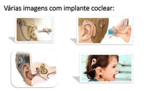 Várias imagens com implante coclear:
 
