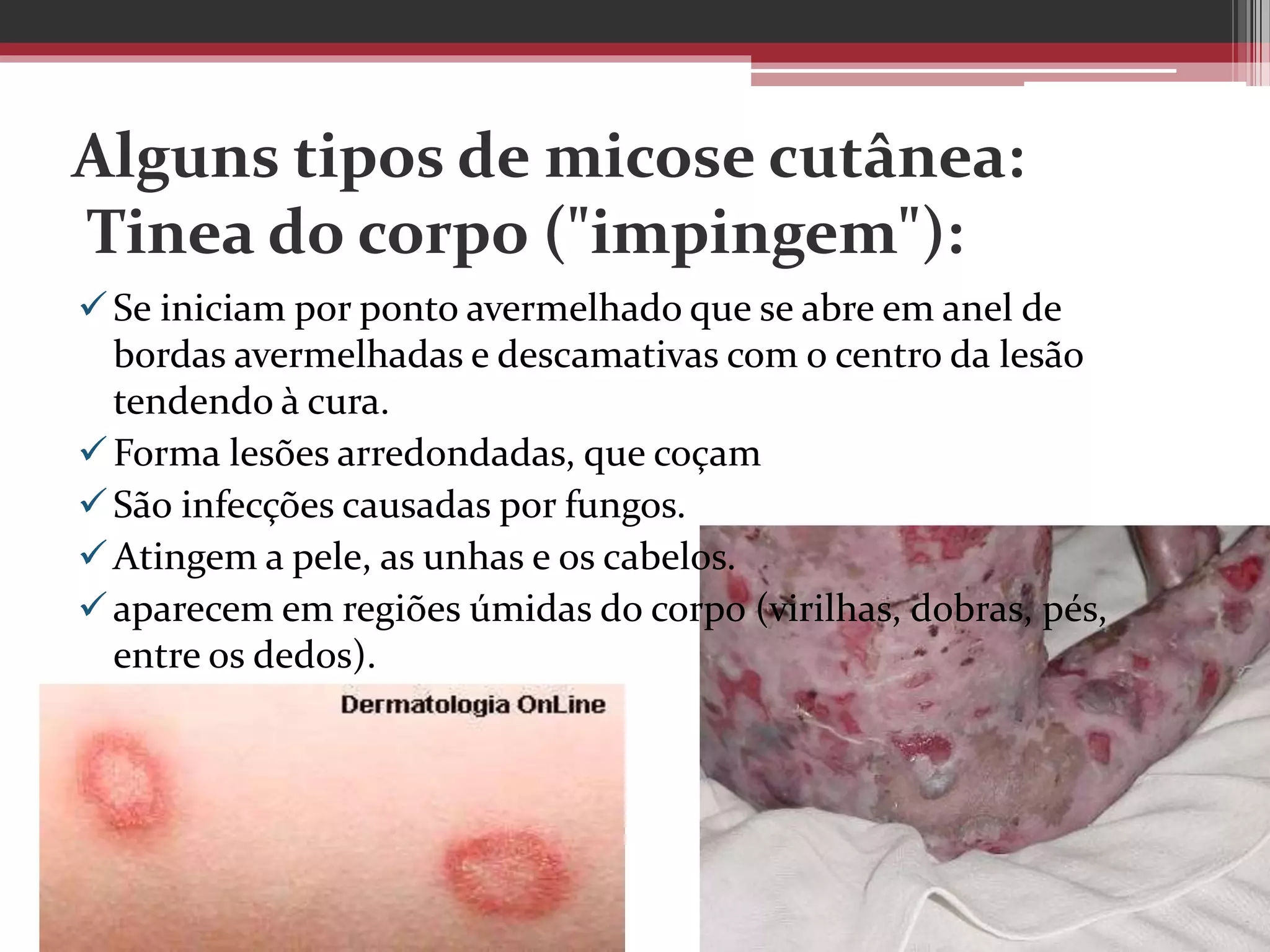 Alguns tipos de micose cutânea:
Tinea do corpo ("impingem"):
Se iniciam por ponto avermelhado que se abre em anel de
bordas avermelhadas e descamativas com o centro da lesão
tendendo à cura.
Forma lesões arredondadas, que coçam
São infecções causadas por fungos.
Atingem a pele, as unhas e os cabelos.
aparecem em regiões úmidas do corpo (virilhas, dobras, pés,
entre os dedos).
 