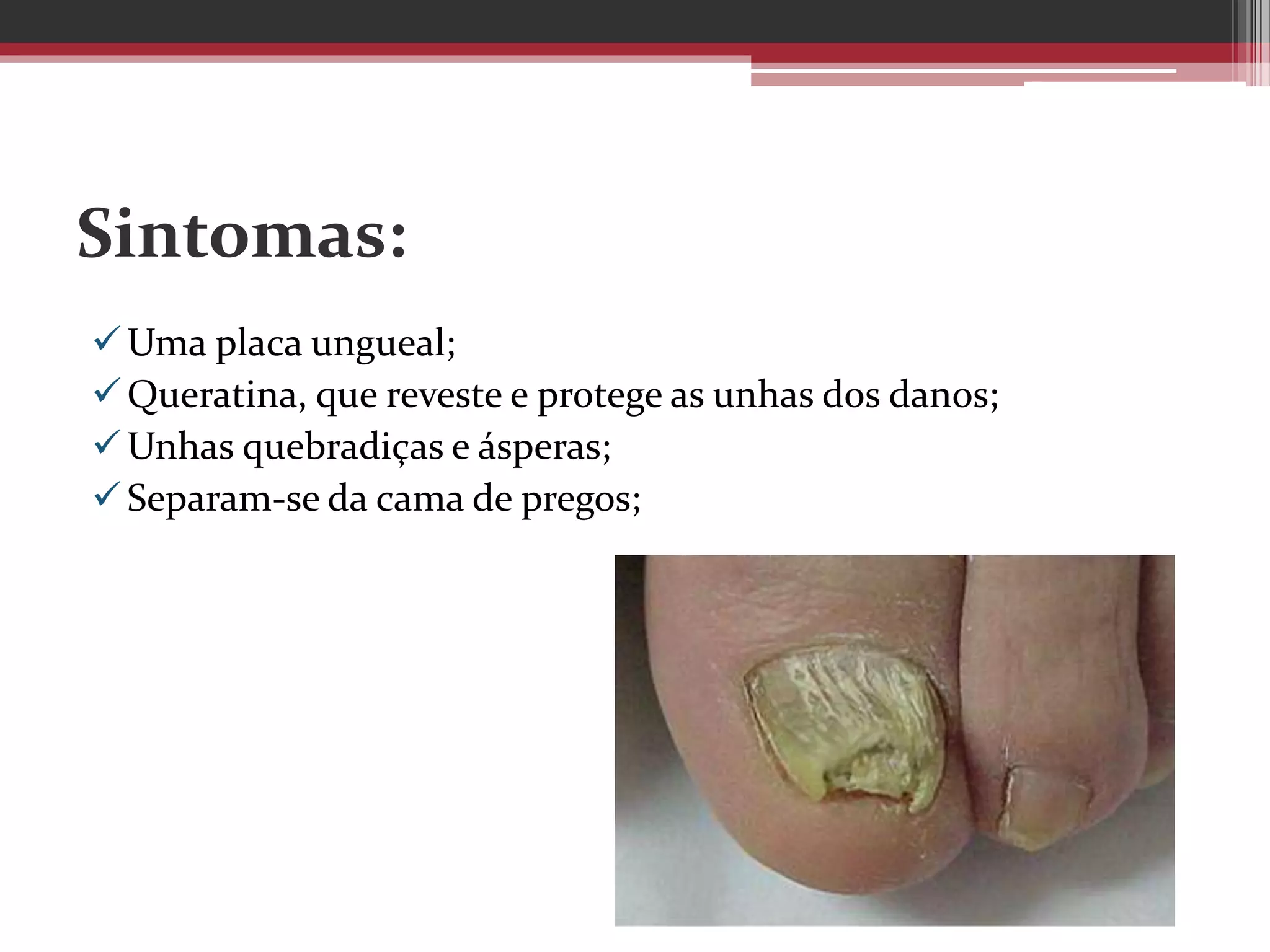 Sintomas:
Uma placa ungueal;
Queratina, que reveste e protege as unhas dos danos;
Unhas quebradiças e ásperas;
Separam-se da cama de pregos;
 