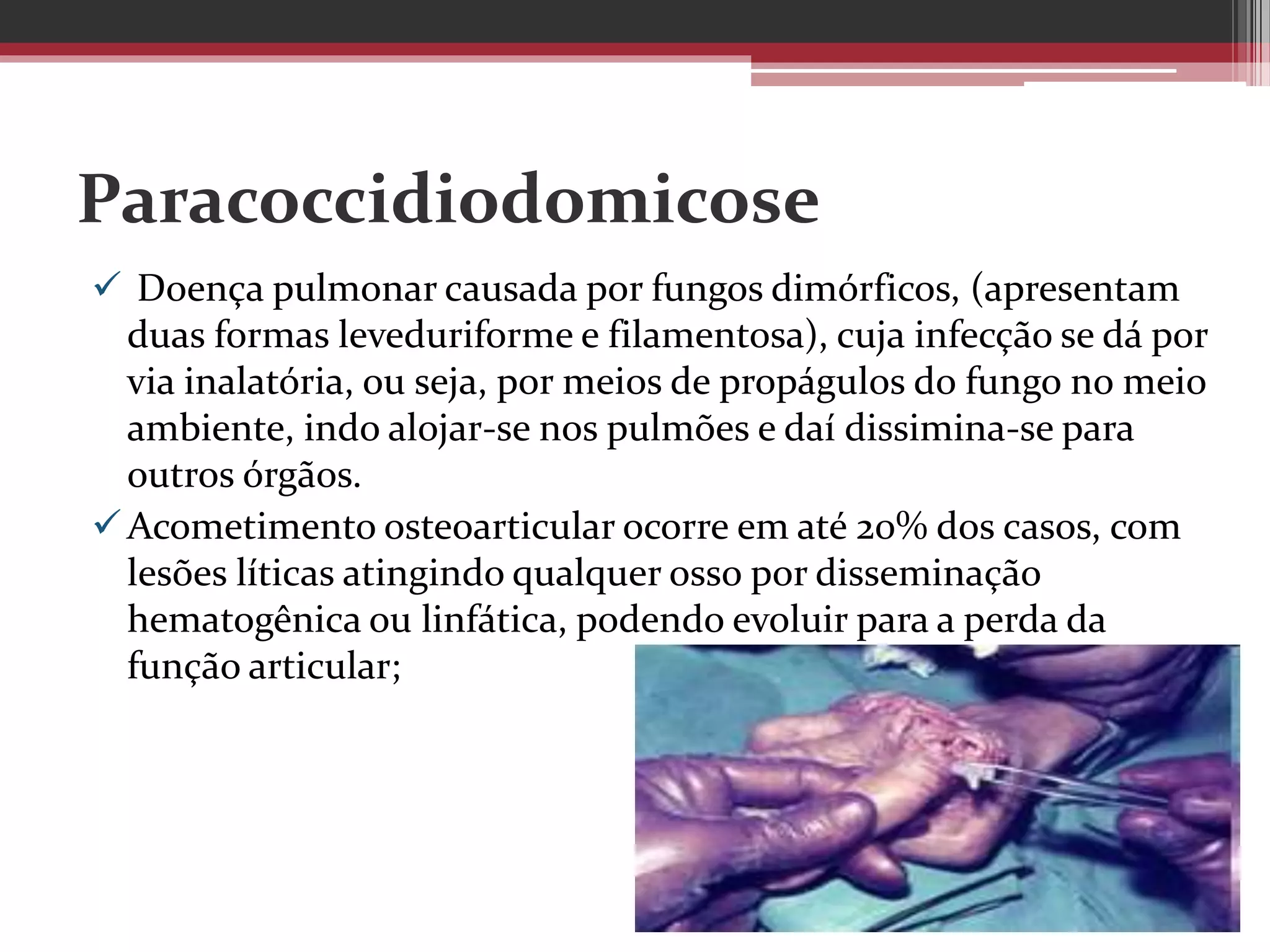 Paracoccidiodomicose
 Doença pulmonar causada por fungos dimórficos, (apresentam
duas formas leveduriforme e filamentosa), cuja infecção se dá por
via inalatória, ou seja, por meios de propágulos do fungo no meio
ambiente, indo alojar-se nos pulmões e daí dissimina-se para
outros órgãos.
Acometimento osteoarticular ocorre em até 20% dos casos, com
lesões líticas atingindo qualquer osso por disseminação
hematogênica ou linfática, podendo evoluir para a perda da
função articular;
 