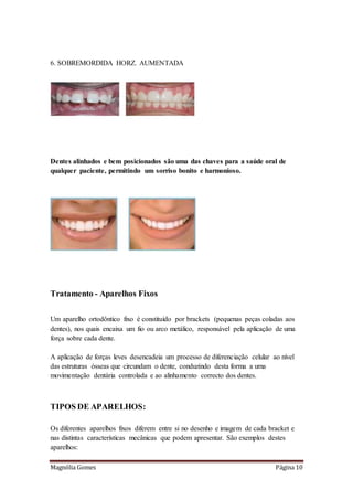 Magnólia Gomes Página 10
6. SOBREMORDIDA HORZ. AUMENTADA
Dentes alinhados e bem posicionados são uma das chaves para a saúde oral de
qualquer paciente, permitindo um sorriso bonito e harmonioso.
Tratamento - Aparelhos Fixos
Um aparelho ortodôntico fixo é constituído por brackets (pequenas peças coladas aos
dentes), nos quais encaixa um fio ou arco metálico, responsável pela aplicação de uma
força sobre cada dente.
A aplicação de forças leves desencadeia um processo de diferenciação celular ao nível
das estruturas ósseas que circundam o dente, conduzindo desta forma a uma
movimentação dentária controlada e ao alinhamento correcto dos dentes.
TIPOS DE APARELHOS:
Os diferentes aparelhos fixos diferem entre si no desenho e imagem de cada bracket e
nas distintas características mecânicas que podem apresentar. São exemplos destes
aparelhos:
 