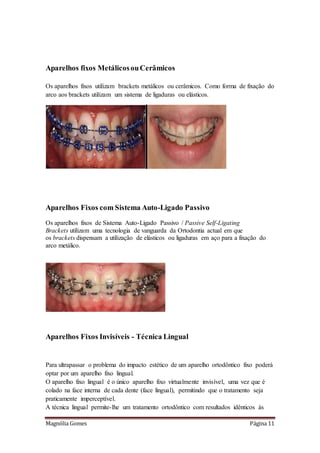 Magnólia Gomes Página 11
Aparelhos fixos MetálicosouCerâmicos
Os aparelhos fixos utilizam brackets metálicos ou cerâmicos. Como forma de fixação do
arco aos brackets utilizam um sistema de ligaduras ou elásticos.
Aparelhos Fixos com Sistema Auto-Ligado Passivo
Os aparelhos fixos de Sistema Auto-Ligado Passivo / Passive Self-Ligating
Brackets utilizam uma tecnologia de vanguarda da Ortodontia actual em que
os brackets dispensam a utilização de elásticos ou ligaduras em aço para a fixação do
arco metálico.
Aparelhos Fixos Invisíveis - Técnica Lingual
Para ultrapassar o problema do impacto estético de um aparelho ortodôntico fixo poderá
optar por um aparelho fixo lingual.
O aparelho fixo lingual é o único aparelho fixo virtualmente invisível, uma vez que é
colado na face interna de cada dente (face lingual), permitindo que o tratamento seja
praticamente imperceptível.
A técnica lingual permite-lhe um tratamento ortodôntico com resultados idênticos às
 