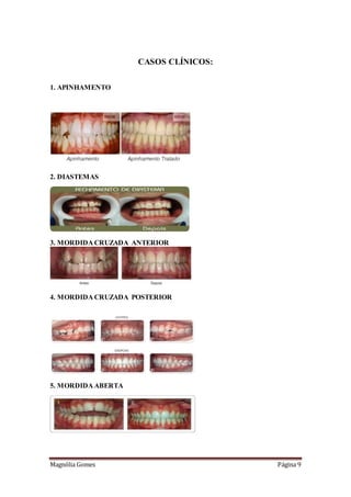 Magnólia Gomes Página 9
CASOS CLÍNICOS:
1. APINHAMENTO
2. DIASTEMAS
3. MORDIDA CRUZADA ANTERIOR
4. MORDIDA CRUZADA POSTERIOR
5. MORDIDA ABERTA
 