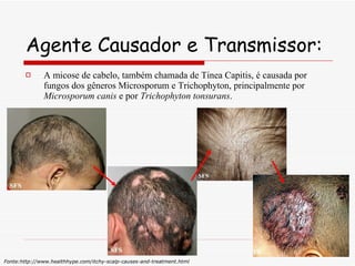 Agente Causador e Transmissor: A micose de cabelo, também chamada de Tinea Capitis, é causada por fungos dos gêneros Microsporum e Trichophyton, principalmente por  Microsporum canis  e por  Trichophyton tonsurans . Fonte:http://www.healthhype.com/itchy-scalp-causes-and-treatment.html 