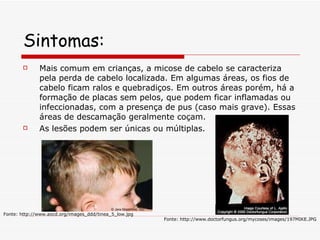 Sintomas: Mais comum em crianças, a micose de cabelo se caracteriza pela perda de cabelo localizada. Em algumas áreas, os fios de cabelo ficam ralos e quebradiços. Em outros áreas porém, há a formação de placas sem pelos, que podem ficar inflamadas ou infeccionadas, com a presença de pus (caso mais grave). Essas áreas de descamação geralmente coçam. As lesões podem ser únicas ou múltiplas.  Fonte: http://www.aocd.org/images_ddd/tinea_5_low.jpg Fonte: http://www.doctorfungus.org/mycoses/images/197MIKE.JPG 