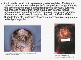A micose de cabelo não apresenta graves seqüelas. Ela tende a regressar espontaneamente, porém é um processo longo. Quando não ocorre esse regresso, a doença pode se acentuar, surgindo nas áreas da micose uma forma aguda com intensa reação inflamatória na pele e formação de pústulas ( pequenos tumores inflamados), com liberação de pus, chamado de Kerion Celsi.  O não tratamento da doença oferece um risco coletivo, já que ela é de fácil propagação. Fonte:http://www.lib.uiowa.edu/Hardin/md/pictures22/cdc/PHIL_2936_lores.jpg Fonte: http://www.ann.hi-ho.ne.jp/haripo/pdata/KERION.JPG   