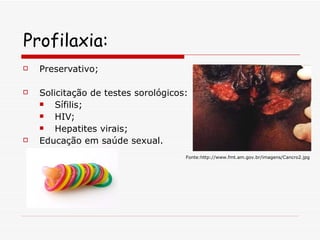 Profilaxia: Preservativo; Solicitação de testes sorológicos: Sífilis; HIV; Hepatites virais; Educação em saúde sexual. Fonte:http://www.fmt.am.gov.br/imagens/Cancro2.jpg 