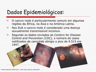 Dados Epidemiológicos: O cancro mole é particularmente comum em algumas regiões da África, na Ásia e na América Latina. Nos EUA o cancro mole é considerado uma doença sexualmente transmissível incomun.  Segundo os dados enviados ao  Centers for Disease Control and Prevention (CDC),  o número de casos notificados de cancróide atingiu o pico de 9.515 em 1947.  Fonte:suburbio.net63.net/.../zine_ed3_cancro_mole.html   