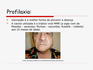 Profilaxia: Vacinação é a melhor forma de prevenir a doença.  A vacina utilizada é a tríplice viral MMR (a sigla vem de Measles - sarampo; Mumps - caxumba; Rubella - rubéola) aos 15 meses de idade.  Fonte: http://www.jornallivre.com.br/208322/o-que-causa-caxumba.html 