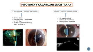 HIPOTONÍA Y CÁMARA ANTERIOR PLANA
CA poco profunda + contacto irido-corneal CA plana + contacto cristalino-córnea
 Córnea clara
 Profundización espontánea
en 7-14 días.
 Si >14d cells endoteliales y
SAP reformar CA
 Córnea edematosa
 Estroma de iris aplando
 Manejo postQx inmediato
 