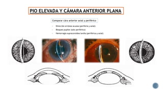 PIO ELEVADA Y CÁMARA ANTERIOR PLANA
- Dirección errónea acuosa (periferia y axial)
- Bloqueo pupilar (solo periférico)
- Hemorragia supracoroidea tardía (periférica y axial)
Comparar cára anterior axial y periférico
 