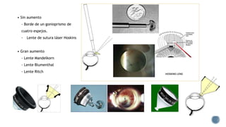 • Sin aumento
- Borde de un gonioprismo de
cuatro espejos.
- Lente de sutura láser Hoskins
• Gran aumento
- Lente Mandelkorn
- Lente Blumenthal
- Lente Ritch
 