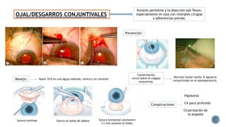 OJAL/DESGARROS CONJUNTIVALES
Durante peritomía y la disección sub-Tenon,
especialmente en ojos con múltiples cirugías
y adherencias previas.
Cauterización
cerca/sobre el colgajo
conjuntival.
Necrosis tisular tardía  agujeros
conjuntivales en el postoperatorio.
Complicaciones
Hipotonía
CA poco profunda
Cicatrización de
la ampolla
Manejo:
Sutura en bolsa de tabacoSutura contínua
Nylon 10-0 en una aguja redonda, cónica y no cortante
Prevención:
Sutura horizontal colchonero
1–2 mm anterior al limbo.
 