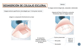DESINSERCIÓN DE COLGAJO ESCLERAL
Colgajo escleral superficial es más delgado que 1/4 de grosor escleral
desgarro o amputación fácilmente de su base
Manejo:
Cápsula de Tenon estirarla y suturarla
firmemente sobre el colgajo escleral
Si colgajo escleral desgarrado, amputado o abotonado
Si conjuntiva
bastante delgada +
ausencia de cápsula
de Tenon.
Esclera preservada
Pericardio
Duramadre
Cubrir la
abertura
escleral
 