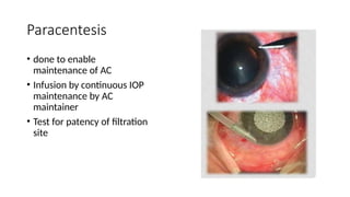 trabeculectomy for Ophthalmology residents.pptx