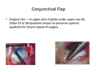 Conjunctival Flap
• Surgical site — in upper part of globe under upper eye lid.
Either ST or SN quadrant chosen to preserve superior
quadrant for future repeat of surgery
 