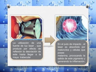 La utilización de una
fuente de luz laser , que
produce por efecto de
reflexión la desviación de
este hasta llegar a la
maya trabecular
En el puto de impacto , el
laser es absorbido por
meloncitos y células que
posee
melanina, provocando la
salida de este pigmento y
generando la inflamación.
 