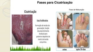 Fases para Cicatrização
Fase de Maturação
 