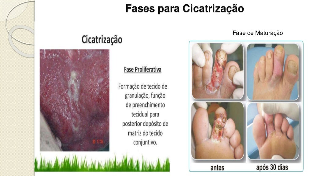 Trabalho sobre feridas Trabalho sobre feridas