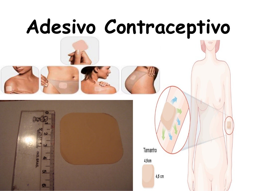 O Método Contraceptivo Tratado Nesse Texto é Denominado