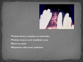 Nódulos firmes, irregulares ou amolecidos Nódulos brancos ou de tonalidade creme Haste do cabelo Diagnóstico diferencial: pediculose. 