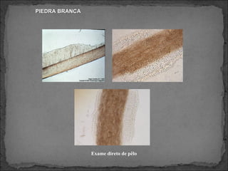 PIEDRA BRANCA Exame direto de pêlo 