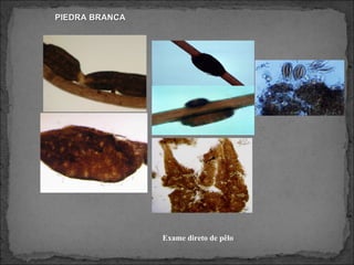 PIEDRA BRANCA Exame direto de pêlo 