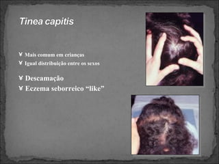Descamação Eczema seborreico “like” Mais comum em crianças Igual distribuição entre os sexos 