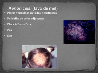 Placas vermelhas elevadas e pustulosas Foliculite de pelos adjacentes Placa inflamatória Pus Dor 