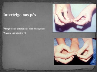 Intertrigo nos pés diagnóstico diferencial com  tinea pedis exame micológico   