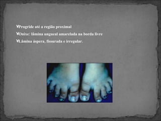 Progride até a região proximal Onixe: lâmina ungueal amarelada na borda livre Lâmina áspera, fissurada e irregular. 