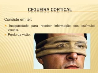 CEGUEIRA CORTICAL
Consiste em ter:
 Incapacidade para receber informação dos estímulos
visuais.
 Perda da visão.
 