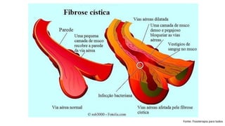 Fonte: Fisioterapia para todos
 