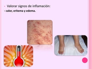 • Valorar signos de inflamación:
- calor, eritema y edema.
 