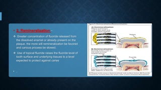 • 2. Remineralization −
 Greater concentration of fluoride released from
the dissolved enamel or already present on the
plaque, the more will remineralization be favored
and carious process be slowed.
 Use of topical fluoride raises the fluoride level of
tooth surface and underlying tissues to a level
expected to protect against caries
• .
 