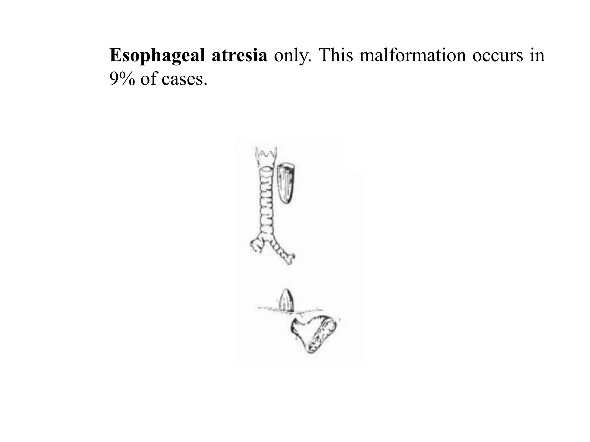 Esophageal atresia only. This malformation occurs in
9% of cases.

 