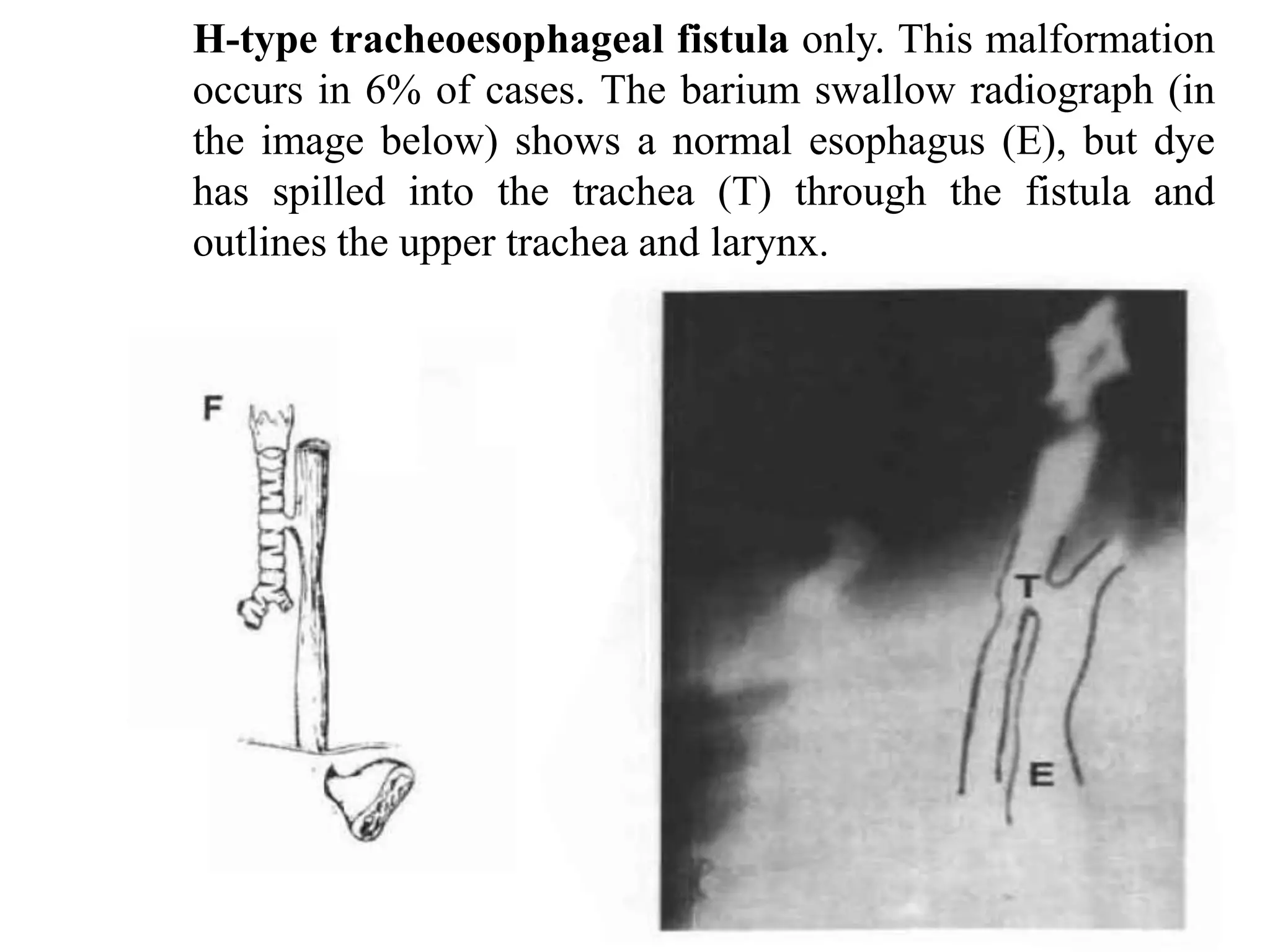 H-type tracheoesophageal fistula only. This malformation
occurs in 6% of cases. The barium swallow radiograph (in
the image below) shows a normal esophagus (E), but dye
has spilled into the trachea (T) through the fistula and
outlines the upper trachea and larynx.

 