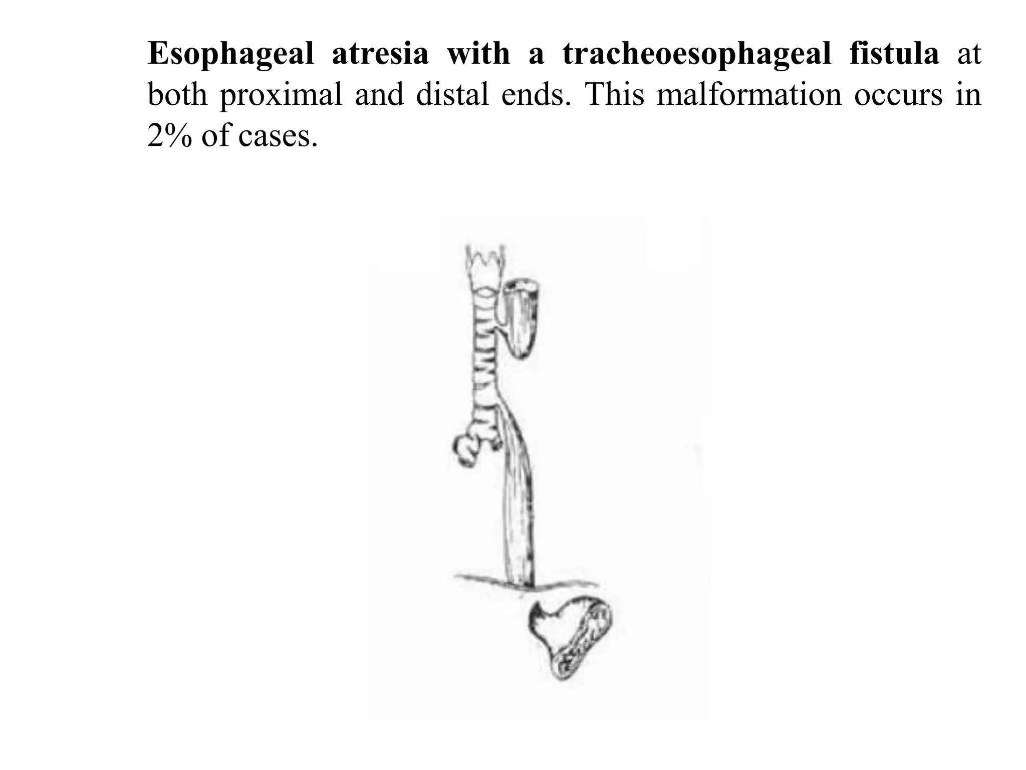 Esophageal atresia with a tracheoesophageal fistula at
both proximal and distal ends. This malformation occurs in
2% of cases.

 