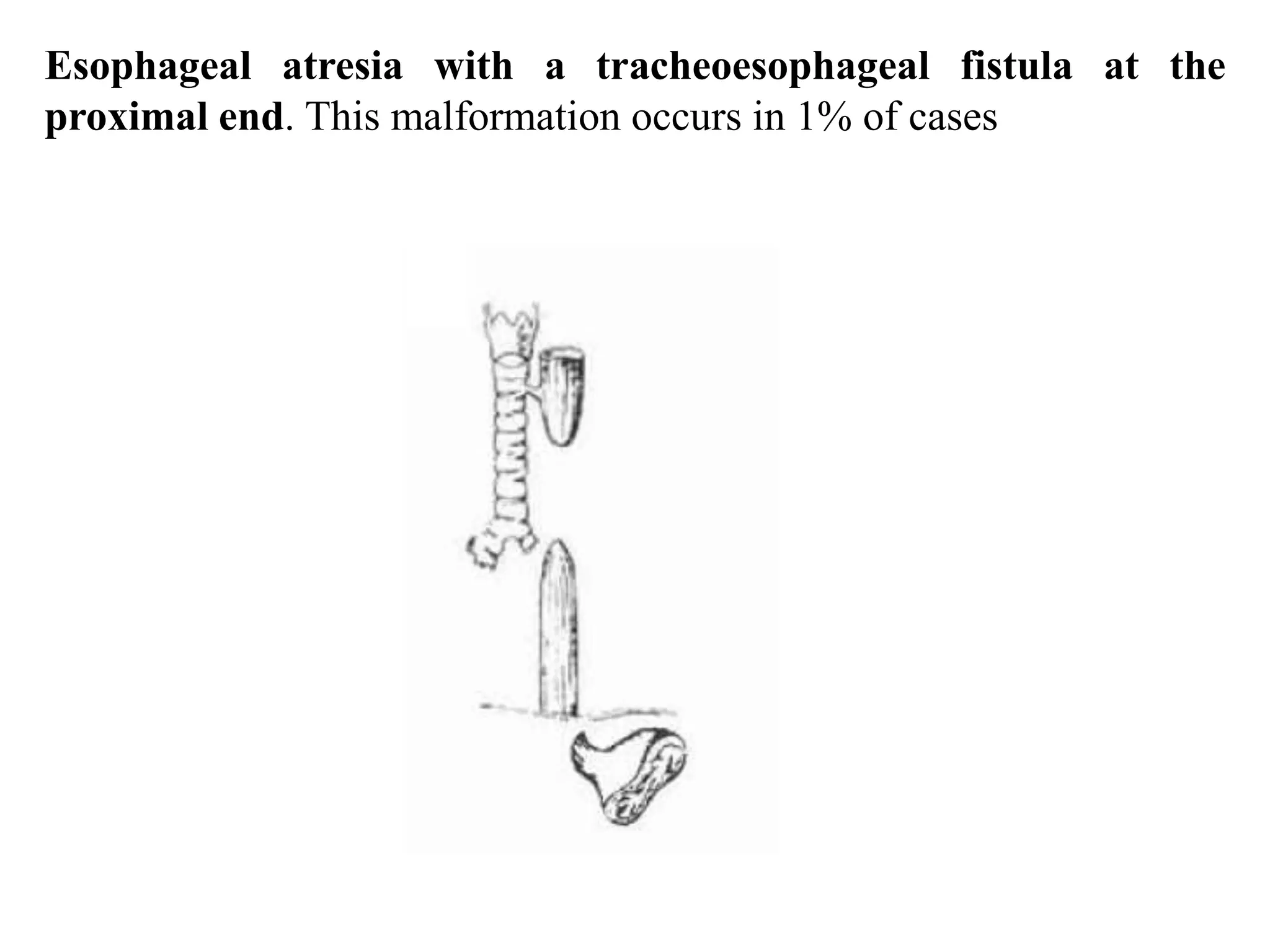 Esophageal atresia with a tracheoesophageal fistula at the
proximal end. This malformation occurs in 1% of cases

 